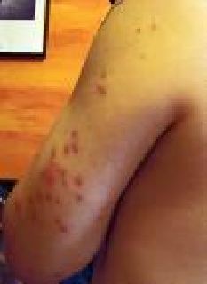 Red bed bug bites on a mans arm